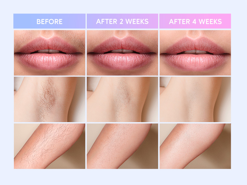 BoSidin Pioneer-Pro Permanent Hair Removal Device